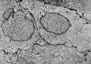 M,8y. | craniopharyngeoma